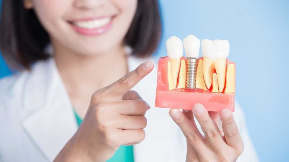 Dental Implants | What are those and why you should go for them?
