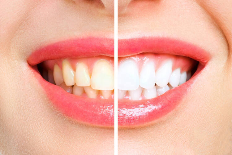 DIY Teeth Whitening Methods and Tips